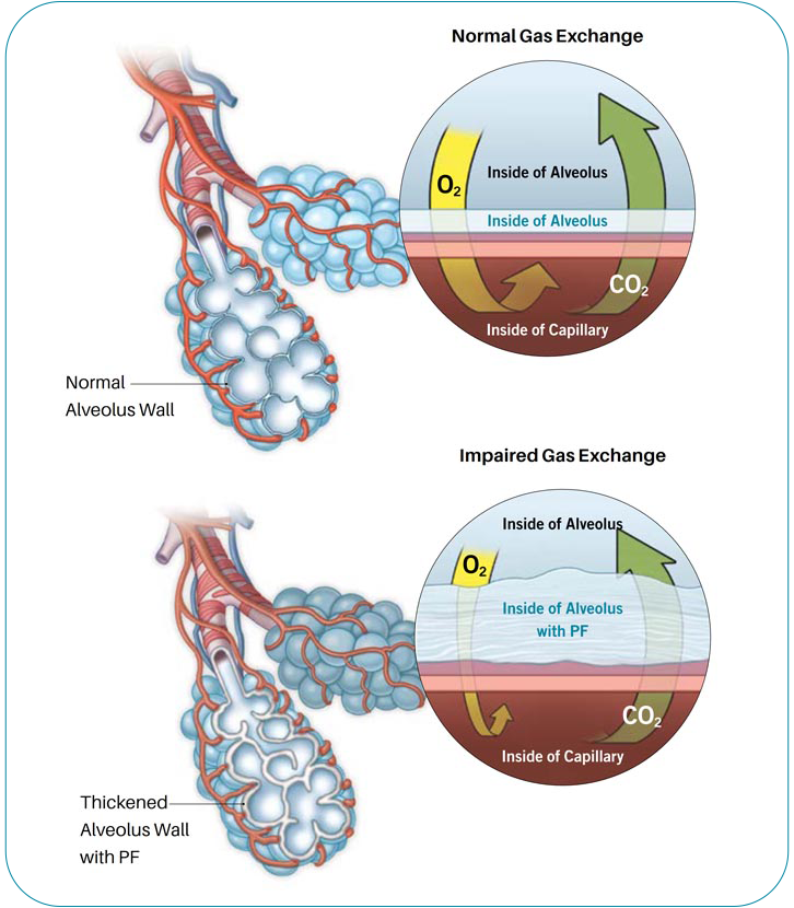 normal-gas-exchange-impaired-gas-exchange-in-lungs